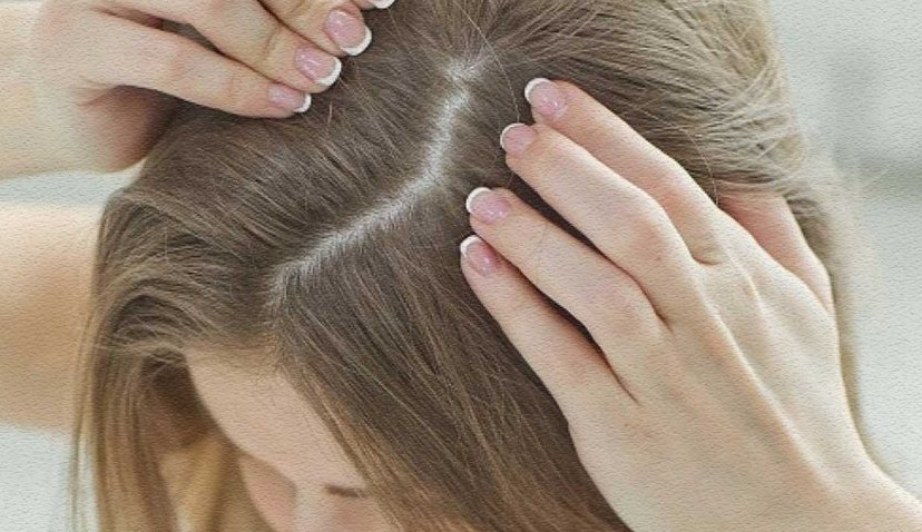 Saç kepeklenmesi çözümü nedir?